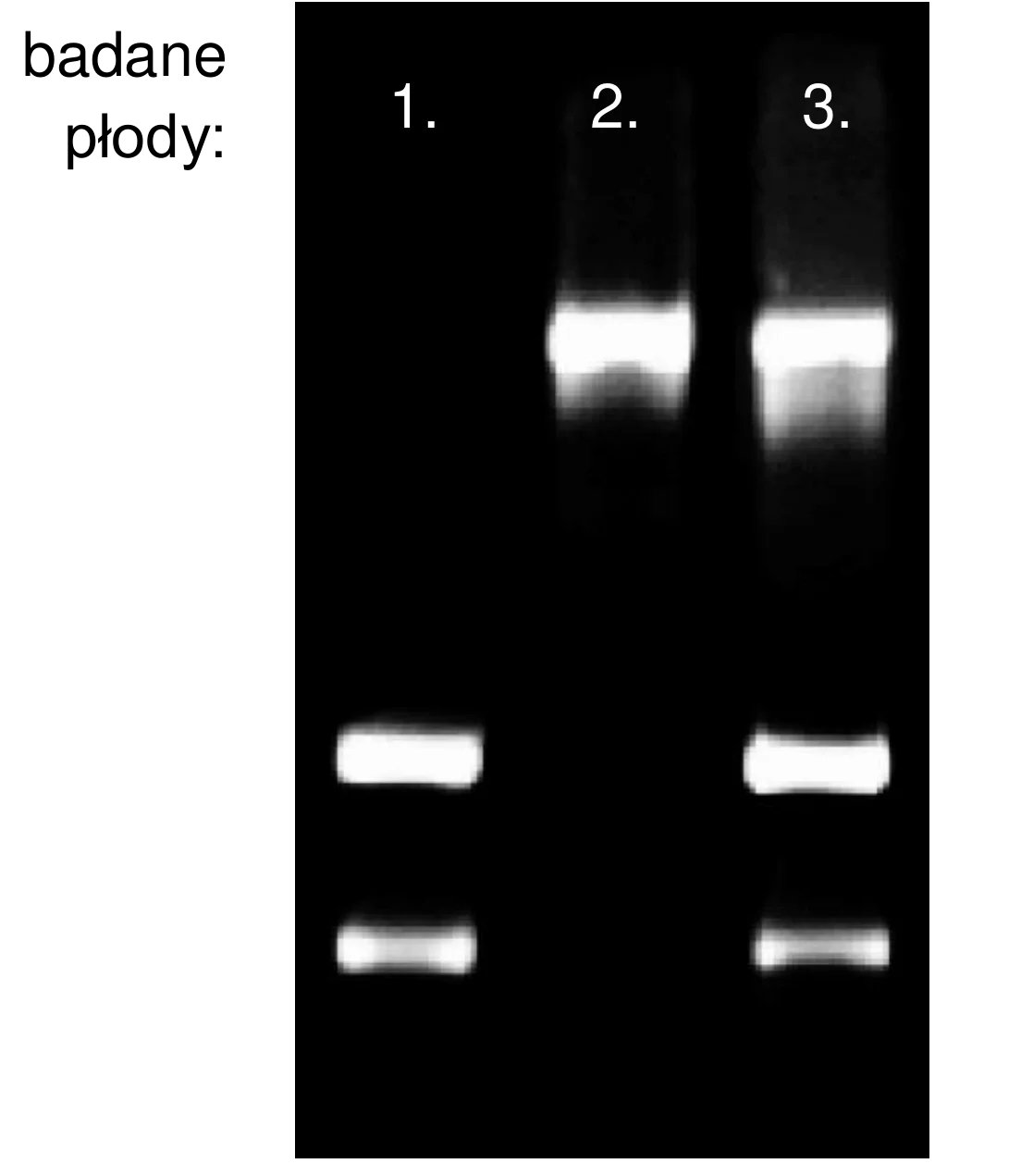 Wynik rozdziału DNA metodą elektroforezy żelowej dla trzech próbek płodów, oznaczonych 1, 2 i 3. Ścieżka 1 pokazuje dwa prążki DNA, ścieżka 2 jeden duży prążek w górnej części, a ścieżka 3 jeden duży prążek górny i jeden dolny.